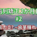歯列矯正2か月目 #2 歯肉炎？~歯茎腫れ＆血だまり ~