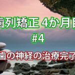 歯列矯正4か月目 #4 / 歯の神経の治療完了