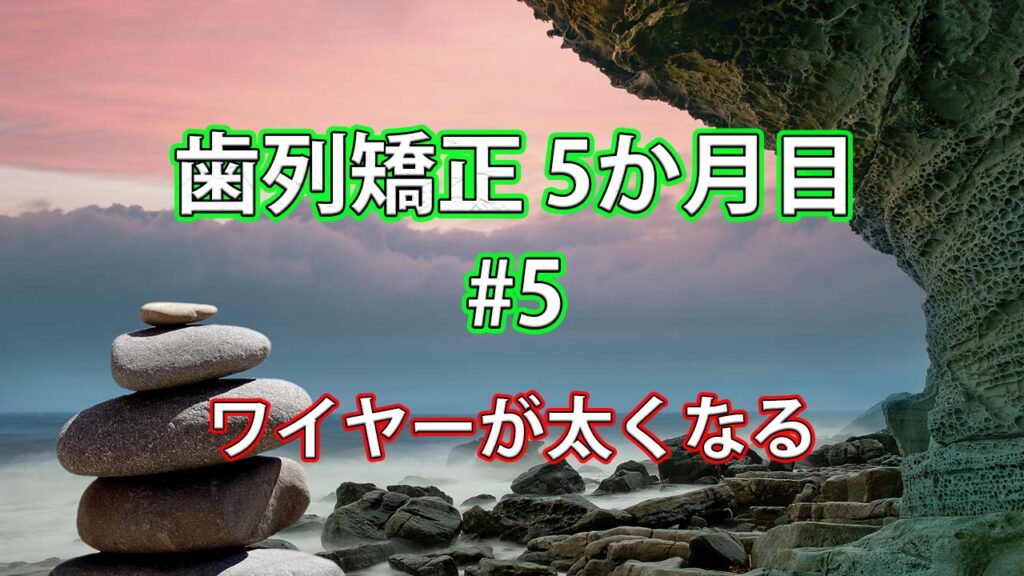 歯列矯正5か月目 #5 / ワイヤーが太くなり、歯が結構動き始める