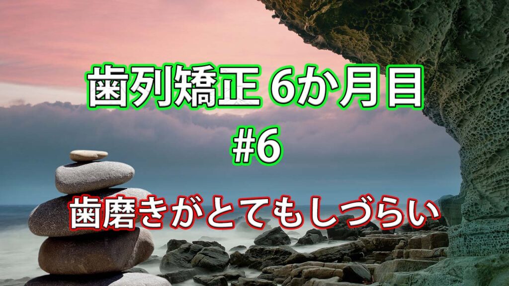 歯列矯正6か月目 #6 / 歯磨きがとてもしづらい