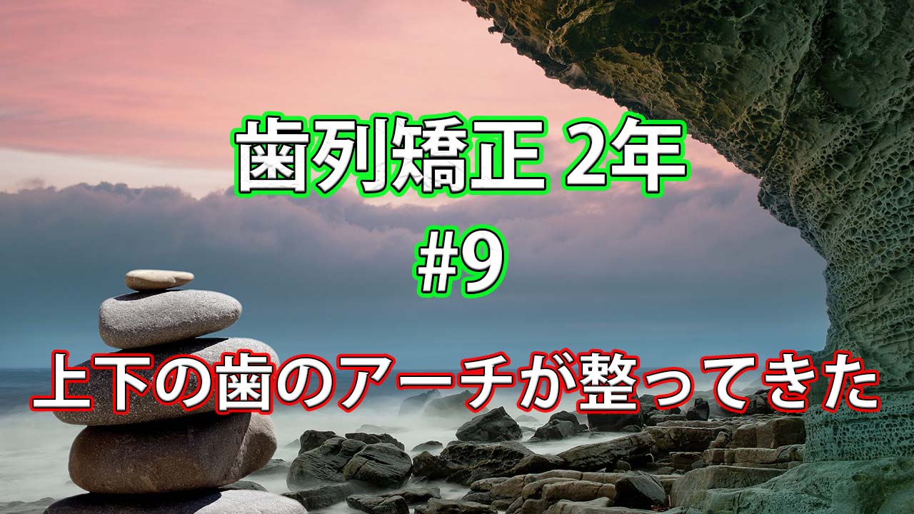 【歯列矯正2年経過】上下の歯のアーチが整ってきた #9